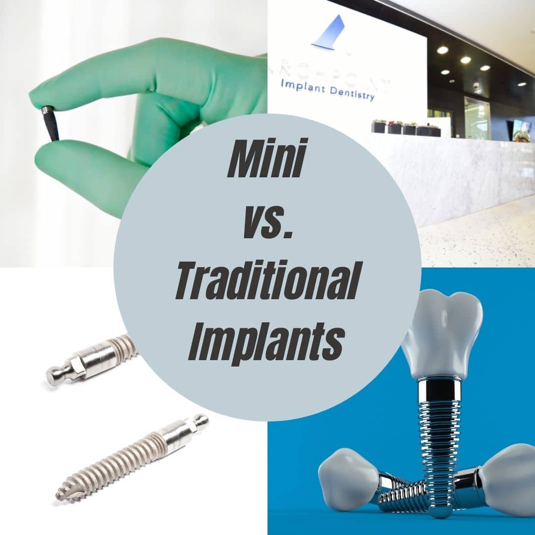 DFW mini dental implants