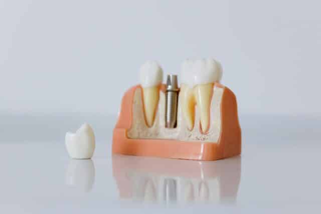 ceramic dental implants