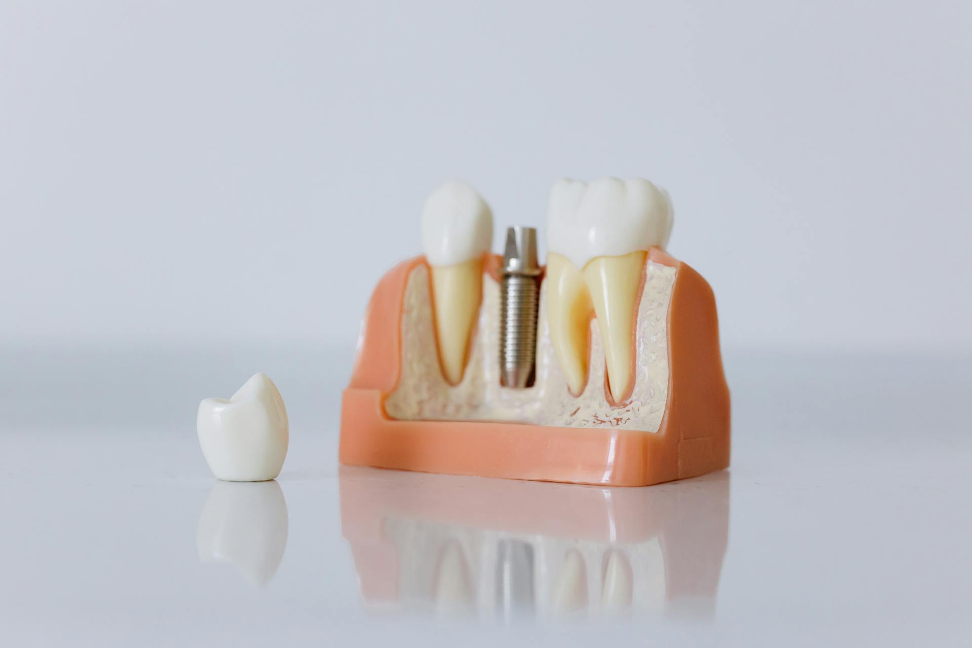 ceramic dental implants