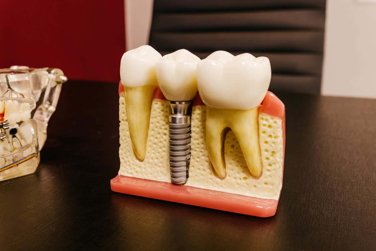 what is a mini dental implant